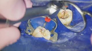 Endodontiste Hugo Setbon  Le retraitement endodontique [upl. by Enowtna]