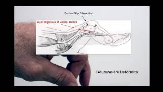 What is a Boutonnière Deformity [upl. by Greeley]