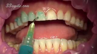 Prepless Veneers Permanent Teeth Whitening [upl. by Leiad389]