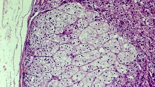 What is Hyperplasia  Pathology mini tutorial [upl. by Ydospahr938]