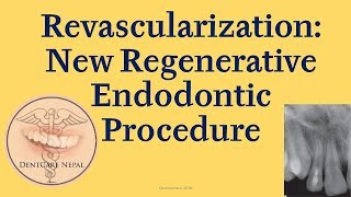 Revascularization  Regenerative Endodontic Procedure [upl. by Ymor]