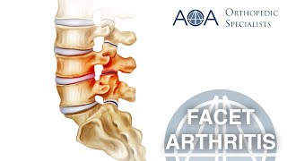 AOA Orthopedic Specialists  Facet Arthritis [upl. by Una]