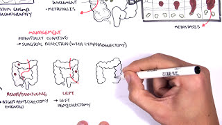 Colorectal Cancer  Overview [upl. by Ellimahs]