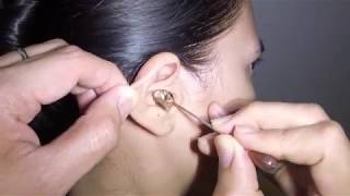 Womans Earwax Finally Removed after 25 Years [upl. by Ianaj]