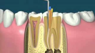 traitement endodontiquedevitalisationflv [upl. by Yamauchi]