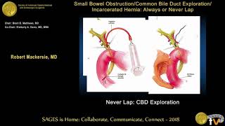 Common bile duct exploration Never laparoscopically [upl. by Eleaffar]