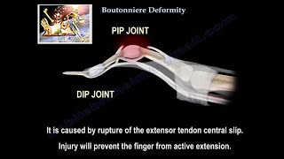 Boutonniere Deformity  Everything You Need To Know  Dr Nabil Ebraheim [upl. by Leumhs]