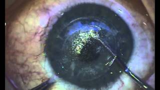 LASIK Surgery and its Risks [upl. by Kilar344]