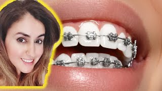 Hacks For Whiter Teeth With Braces [upl. by Nylrac699]