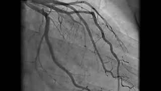 Heart Stent Surgery [upl. by Hgielar]