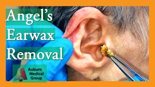 Angels Earwax Removal  Auburn Medical Group [upl. by Aivekal]