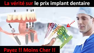 Prix implant dentaire  partie 1 [upl. by Cicily]