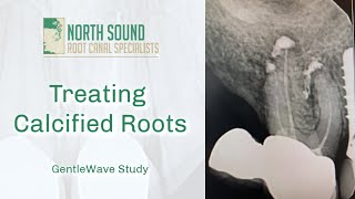 Root Canal Treatment on a Calcified Tooth GentleWave® [upl. by Nnylyahs]