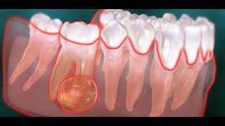 Abcès endodontique dentaire kyste [upl. by Senalda135]