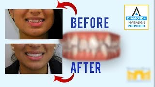 Invisalign Before and After Crowded Teeth [upl. by Alamac]