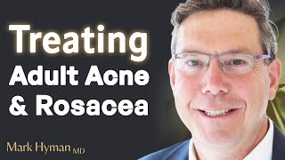 Treating Adult Acne amp Rosacea From The Inside Out [upl. by Hayashi]