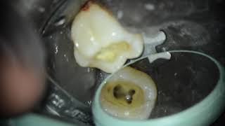 Traitement endodontique  Canal Mésio Central  36 [upl. by Silado]