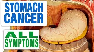 Stomach Cancer Causes Signs and Symptoms Diagnosis and Treatment [upl. by Kendell992]