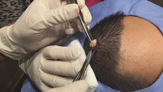 This Cyst amp Blackhead Are No Match for Dr Pimple Popper [upl. by Philbert]