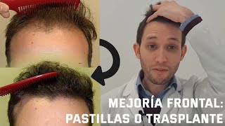 DERMATÓLOGO explica cómo mejorar la ALOPECIA ANDROGÉNICA FRONTAL [upl. by Hras570]