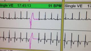 ECG 111 HOLTER CON EXTRASISTOLES VENTRICULARES BIGEMINADAS Y PAREADAS ASOCIADAS ISQUEMIA SILENCI [upl. by Isolde]