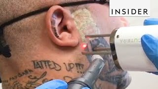 Eliminación de Tatuajes  Insider Español [upl. by Rednave]