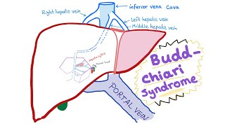 BuddChiari syndrome  Definition Causes Pathophysiology Diagnosis amp Treatment  Hepatology [upl. by Odlareg110]