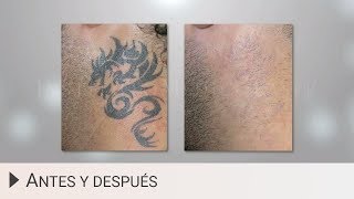 Eliminar tatuajes con láser  Antes y después [upl. by Alesi414]