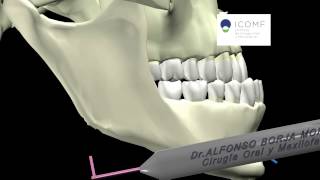 ORAL Y MAXILOFACIAL Le Fort I osteotomia FASE 34 Osteotomia [upl. by Nnylhsa868]