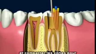 Le traitement de canal dentaire Clinique Dentaire Orozen [upl. by Ynots]