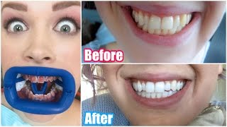 My Professional Teeth Whitening Experience BEFORE amp AFTER [upl. by Narut]