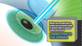 Does LASIK Eye Surgery Hurt [upl. by Yntruoc]