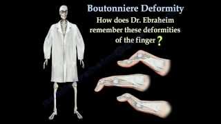 Boutonniere Deformity  Everything You Need To Know  Dr Nabil Ebraheim [upl. by Line]