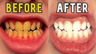 How I Whitened My Teeth in 14 Days [upl. by Tonie]