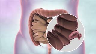 What are the signs of end stage colon cancer  Dr Rajasekhar M R [upl. by Eocsor166]