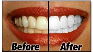 How I Whiten My Teeth At Home [upl. by Sergeant477]