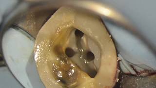 Traitement endodontique sous microscope 4 canaux  27 [upl. by Bolten466]