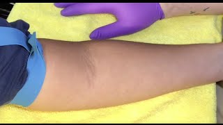 Tips For Locating Difficult Veins [upl. by Llirret]