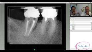 La chirurgie endodontique  le choix de la conservation [upl. by Ogden704]